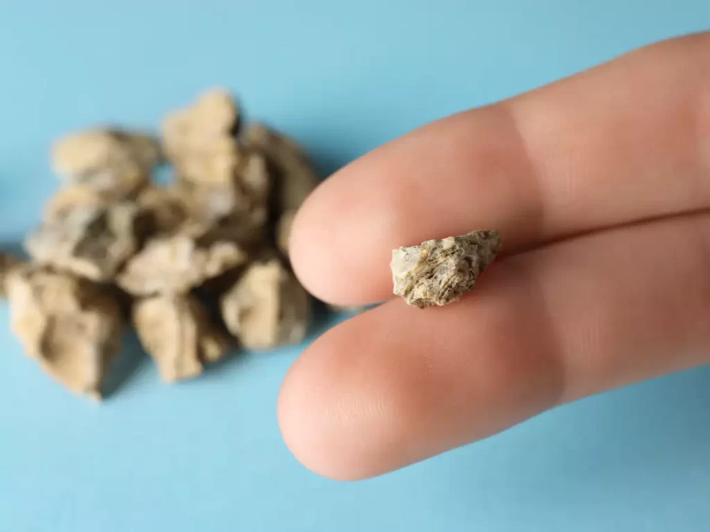 10 mm böbrek taşını nasıl düşürdüm ?